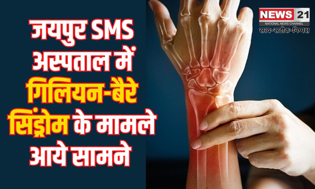 GBS Cases Also In Jaipur SMS: जयपुर के एसएमएस हॉस्पिटल में गुइलेन-बैरे सिंड्रोम के तीन केस मिले: प्रशासन अलर्ट
